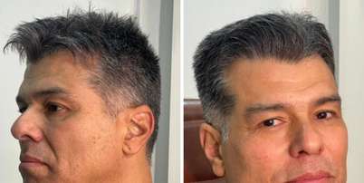 Maur&iacute;cio Mattar, antes e depois Foto: Reprodu&ccedil;&atilde;o | Instagram
